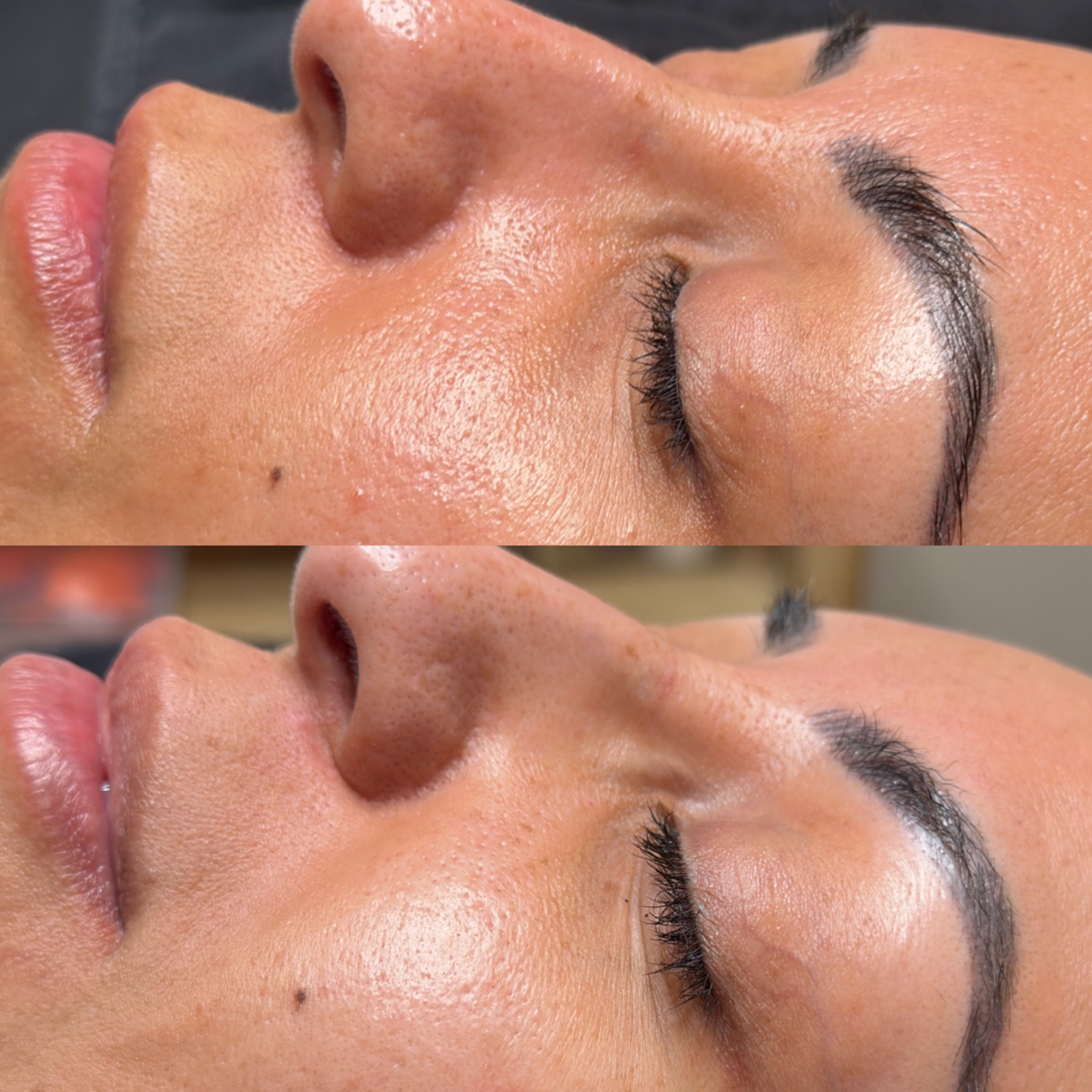 Before and after Procell showing a reduced appearance of pores