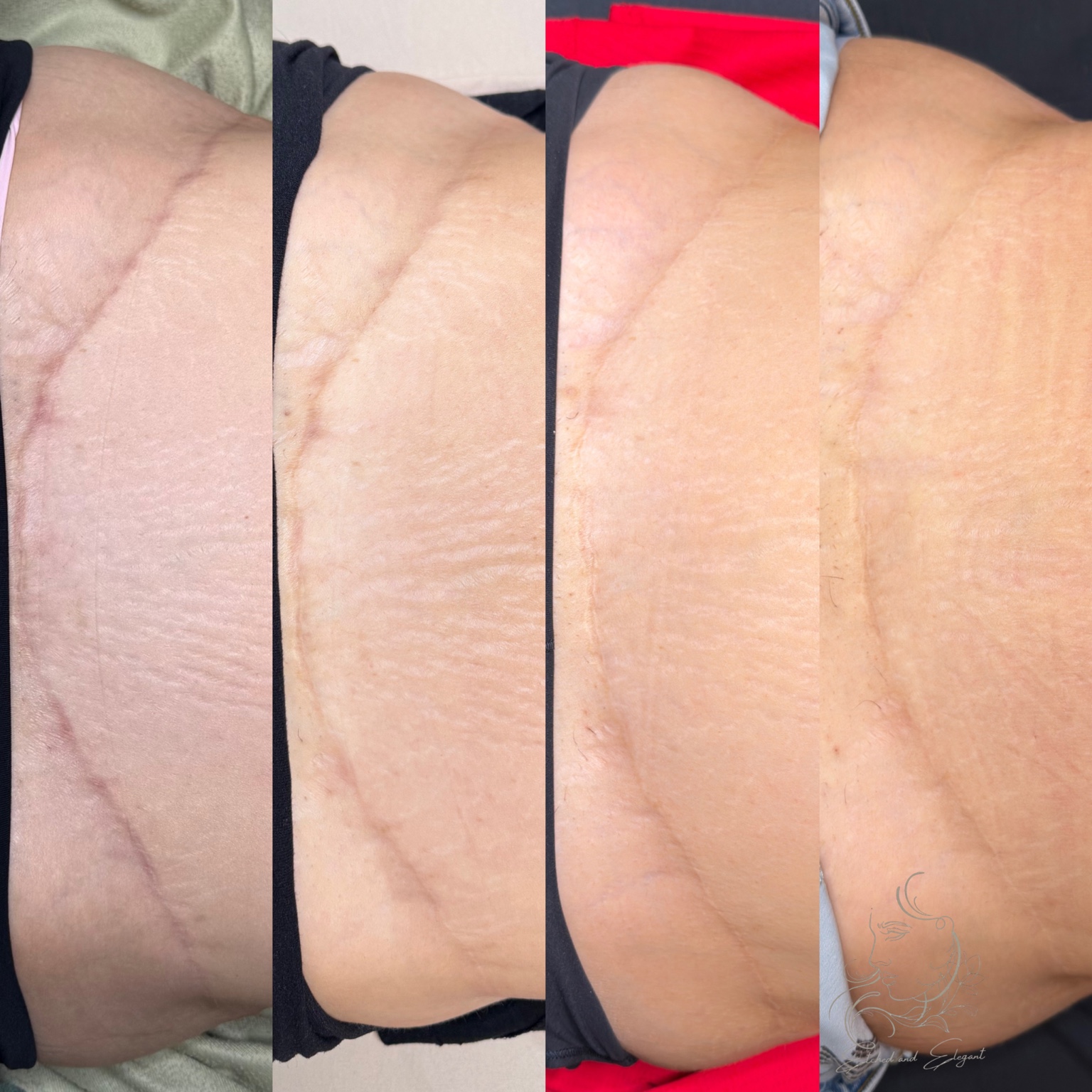 Four progress photos of a tummy tuck scar following Procell treatments